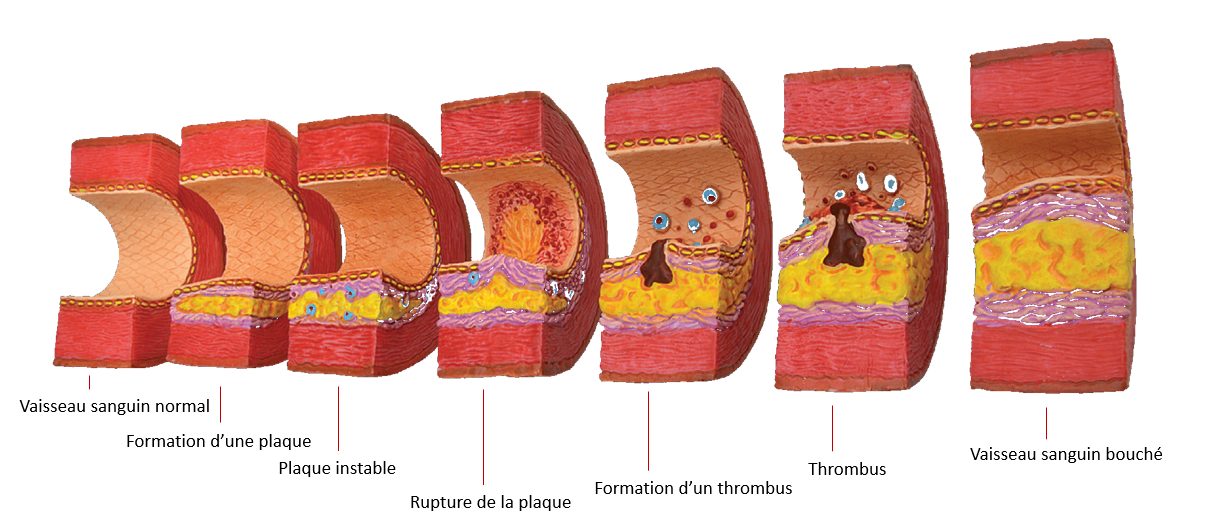Schéma de l'athérosclérose dans les vaisseaux sanguins